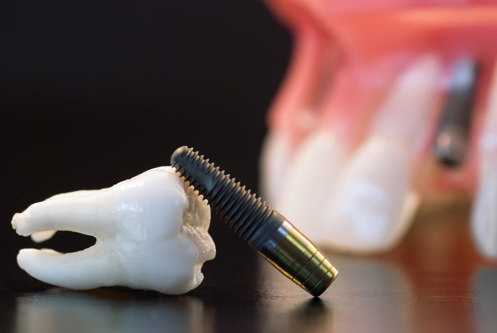 How Long Does It Take To Get A Dental Implant?