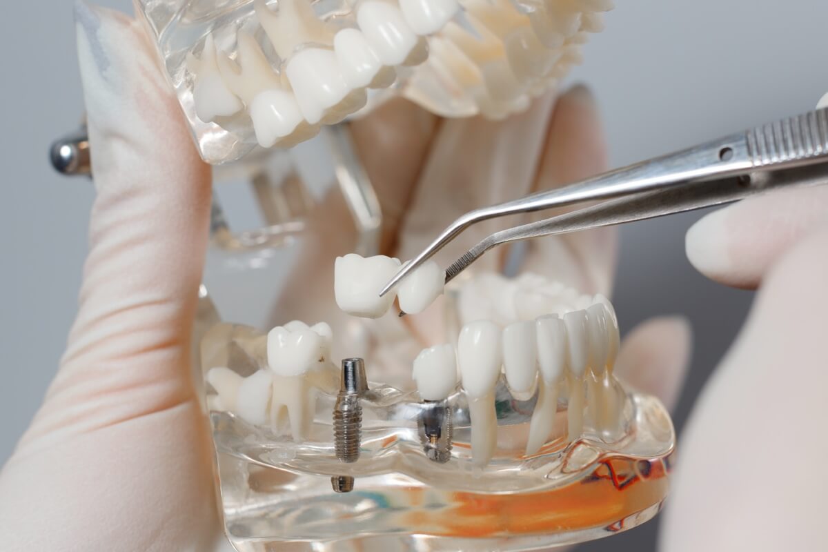 Will Dental Implants Become Cheaper?