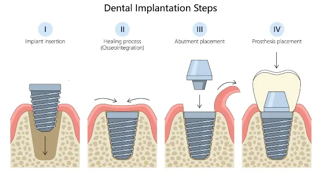 The Biocompatible Bond Osseointegration